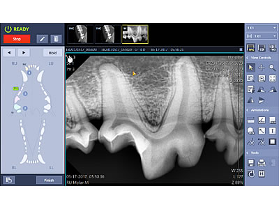 歯科用レントゲン解析ソフト「Ez dentvet」